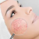 Couperose Skin: Skaistumkopšanas līdzekļi: simptomi, ārstēšana, skaistumkopšanas līdzekļi